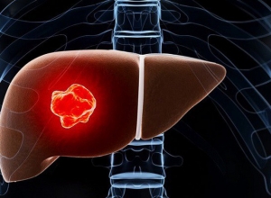 9 dấu hiệu cảnh báo ung thư gan giai đoạn đầu bạn tuyệt đối đừng nên chủ quan